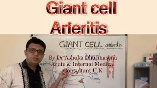Giant cell Arteritis