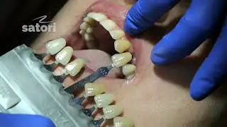 How to insert one tooth without grinding the adjacent ones.