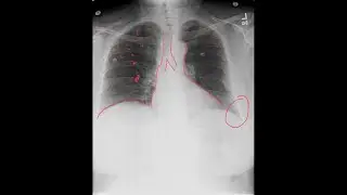CXR basics