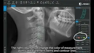 AI analysis of head silhouette to measure bone age
