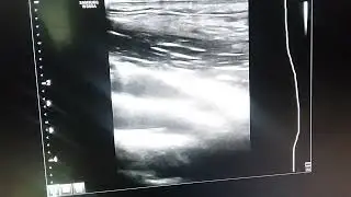 CCA intimal tearing flap or miror image?CTA is normal.