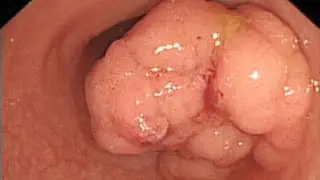 Colon cancer being found in younger patients