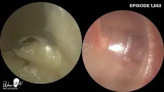 1,563 - Otomycosis Discharge Removed using Angled Curette in Patient with Suspected Paraganglioma