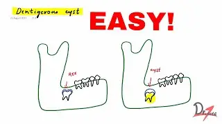 Dentigerous cyst made easy!
