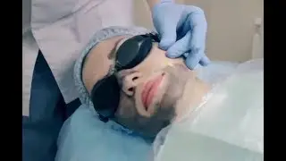 Карбоновый пилинг в Новосибирске на лазере Fotona
