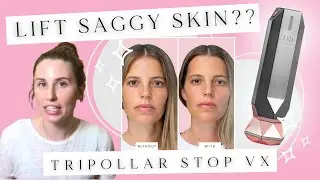 Skin Tightening At Home: Tripollar STOP VX REVIEW | Does At Home Radio Frequency Treatment Work?