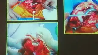Infected TKR management