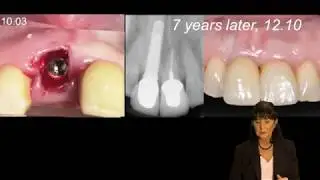 Immediate vs. late implantation replacing multiple adjacent missing teeth in the anterior maxilla