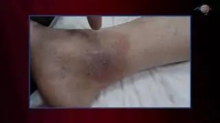 WCW: Excellent Outcomes for Patient with Venous Disease