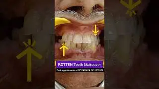 ROTTEN Teeth Makeover: Dr. Srishti Bhatia 