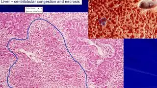 Liver: Chronic venous congestion