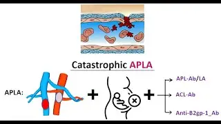 APLA (Anti-phospholipid Antibody Syndrome) & CAPS (Catastrophic APLA)_Dr Pradeep Rangappa