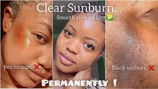 Best Brightening face creams for SUNBURN✅️/how to clear sunburn permanently #sunburn