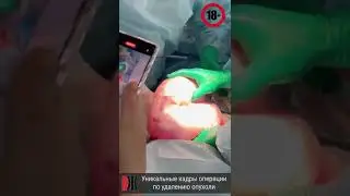 Уникальные кадры операции по удалению опухоли. Контент 18+
