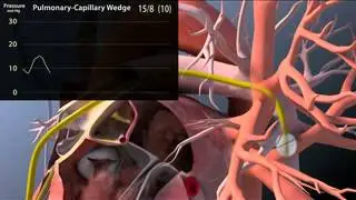 Pulmonary artery Catherization NEJM
