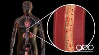 Type 2 Diabetes
