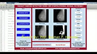 CNN Breast Cancer Identification Using Matlab Project With Source Code | Breast Cancer Detection