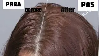HOW TO STOP OILY/GREASY HAIR!!