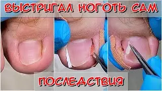 Вросший ноготь / Выстригал вросший ноготь сам / Тампонада вросшего ногтя / Врос на ноге что делать