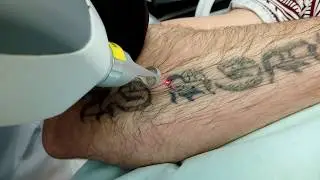 Лазерное удаление тату