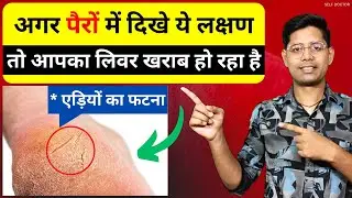 लिवर खराब होने के 4 शुरुआती लक्षण | liver kharab hone ke lakshan kya hai | SELF DOCTOR