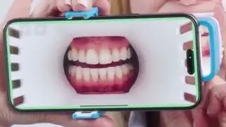 Invisalign remote monitoring explained
