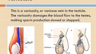 Male Infertility