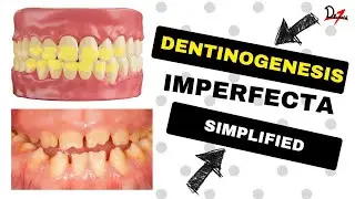 Dentinogenesis Imperfecta Type 2