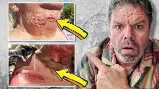 Inspire Implant Horror Stories 🫣 : My Nightmare Experience!