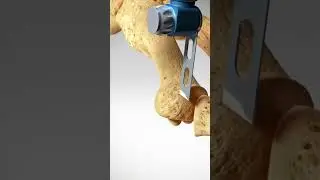 See how a Bunion is treated (Bunionectomy with Osteotomy) 