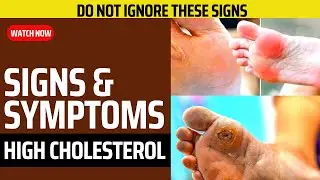 STOP! ✋You Should Never Ignore These 9 Signs & Symptoms of High Cholesterol 😱😱😱