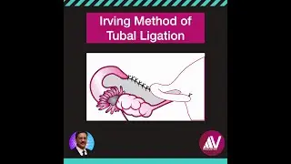Irving Method of Tubal Ligation