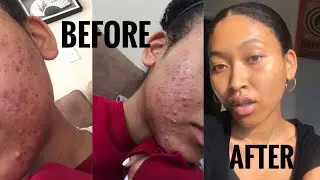 HOW I CLEARED MY TERRIBLE ACNE // HELPING YOU CLEAR YOURS