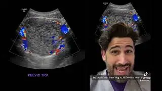 Molar Pregnancy - Hydatidiform Mole