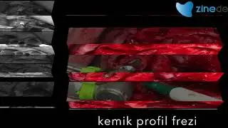 Zinedent Bone Prifiler