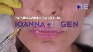 Popunjavanje bora hijaluronom, estetska medicina u IOANNA REGEN Klinici