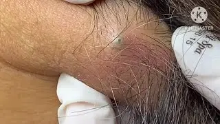 sebaceous cyst behind the neck 