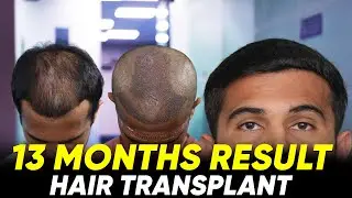 Hair Transplant in Vellore | Best Results & Cost of Hair Transplant in Vellore