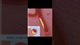 O que é o infarto do miocárdio? #anatomy #fisiologia #medstudent #fisiopatologia #biologia #fisio