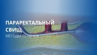 Методики лечения параректального свища