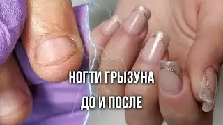 Съеденные ногти. Наращивание на сложных руках. Ногти грызуна.