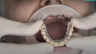 Full arch rehabilitation with implants | Simplifying the complex with iTero™ intraoral scanners