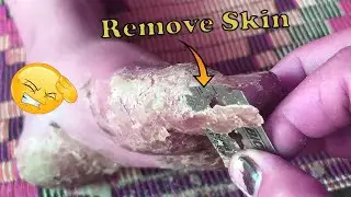 How to removal skin | callus removal skin flakes #46
