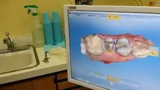 Broken Tooth Repair In Lisbon CT