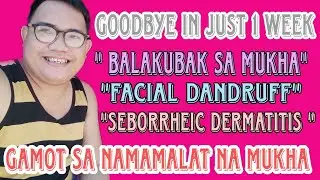 Namamalat Na Mukha | Balakubak sa Mukha | Seborrheic Dermatitis | Facial Dandruff