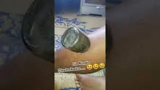 Bekam Tradisional (Bisul) 