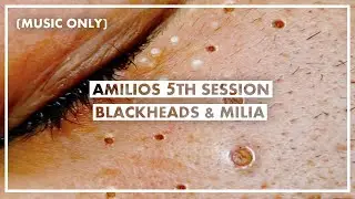 Amilios 5th Session - Blackheads And Milia Extraction On The Face (Only With Music)