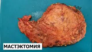 Рак молочной железы (радикальная мастэктомия) - гистологическое исследование (вырезка)