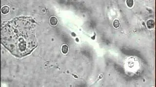 ПКТ отрицательный 6