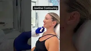 Jawline contouring using fillers